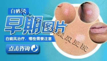 为什么大部分的白斑出现在面部