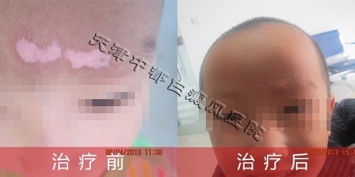 白癜风治疗前后对比图