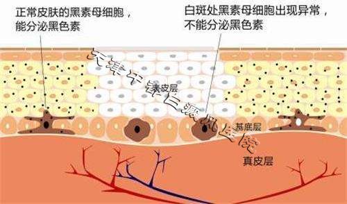 白癜风康复关键